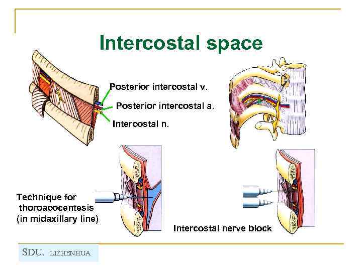 Intercostal space Posterior intercostal v. Posterior intercostal a. Intercostal n. Technique for thoroacocentesis (in