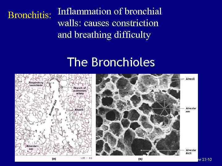 Bronchitis: Inflammation of bronchial walls: causes constriction and breathing difficulty The Bronchioles Figure 23–