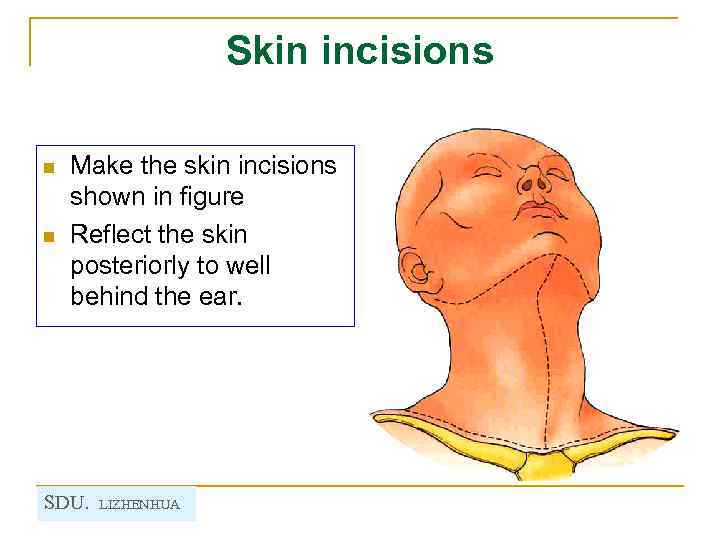 Skin incisions n n Make the skin incisions shown in figure Reflect the skin