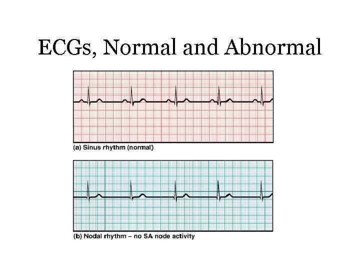 ECGs, Normal and Abnormal 