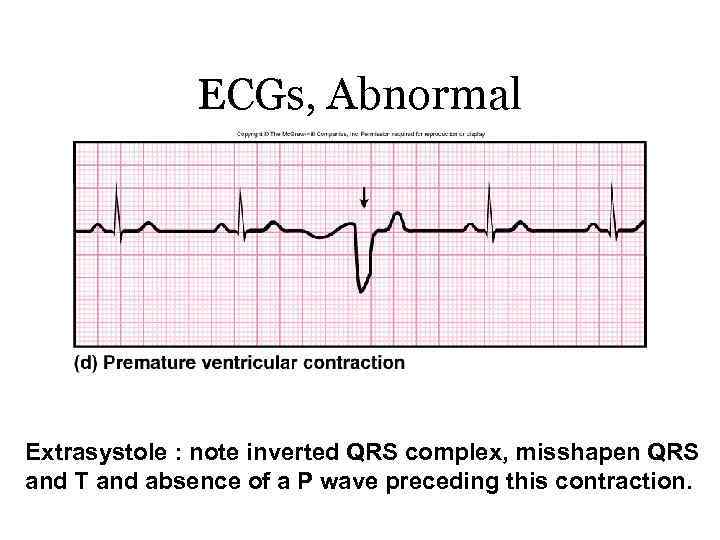 ECGs, Abnormal Extrasystole : note inverted QRS complex, misshapen QRS and T and absence