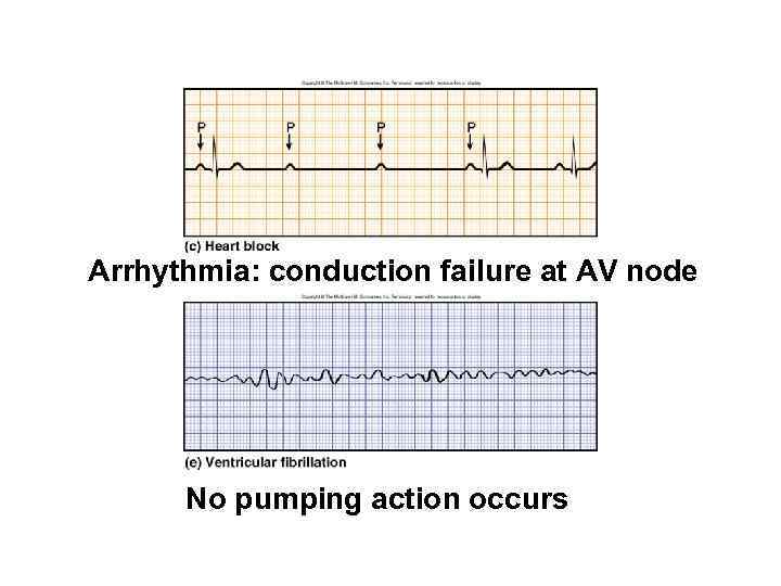 ECGs, Abnormal Arrhythmia: conduction failure at AV node No pumping action occurs 