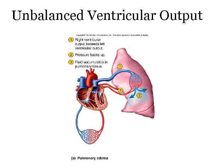 Unbalanced Ventricular Output 