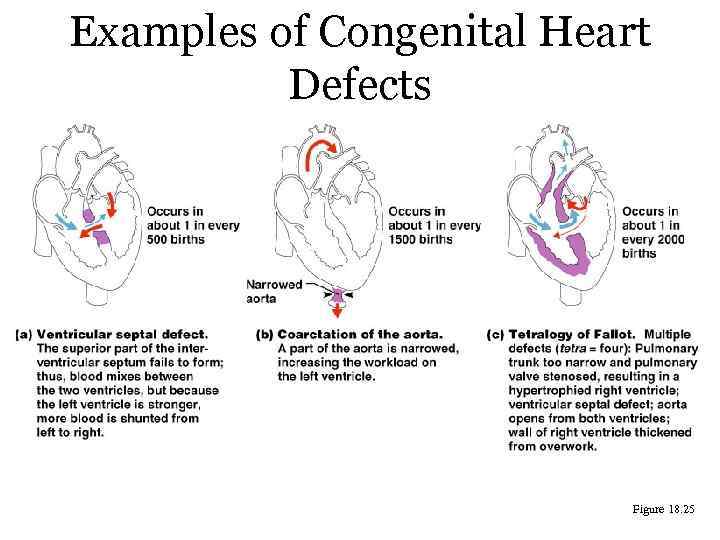 Examples of Congenital Heart Defects Figure 18. 25 