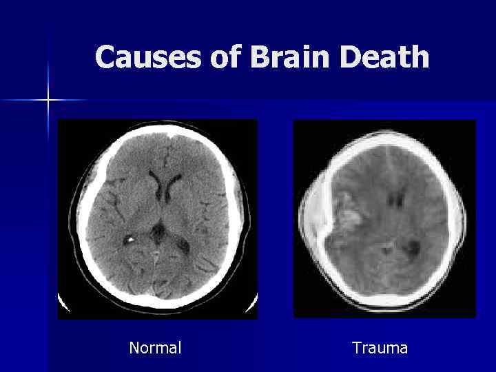 Causes of Brain Death Normal Trauma 