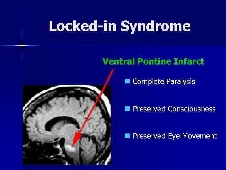Locked-in Syndrome Ventral Pontine Infarct n Complete Paralysis n Preserved Consciousness n Preserved Eye