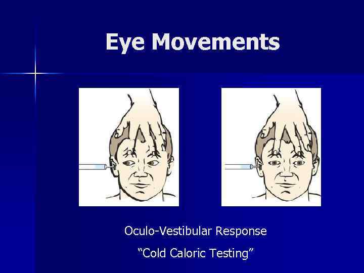 Eye Movements Oculo-Vestibular Response “Cold Caloric Testing” 