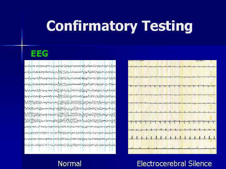 Confirmatory Testing EEG Normal Electrocerebral Silence 