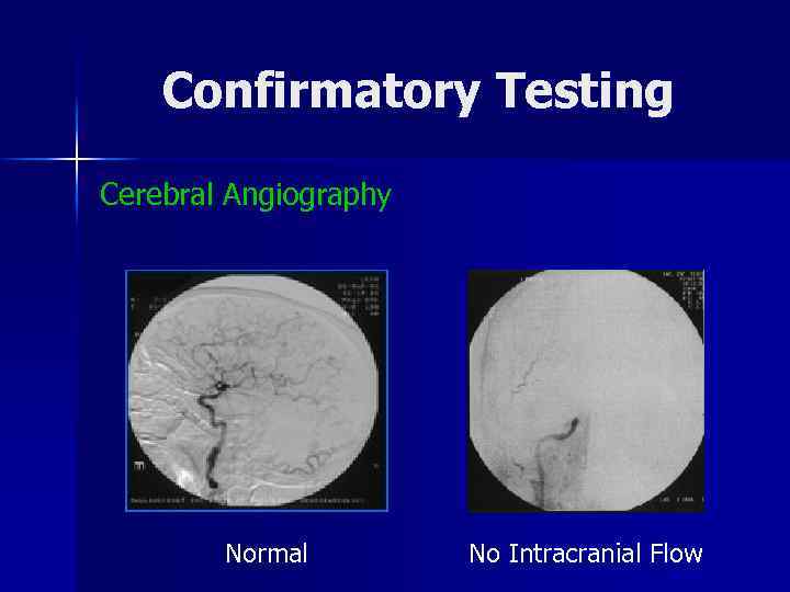 Confirmatory Testing Cerebral Angiography Normal No Intracranial Flow 