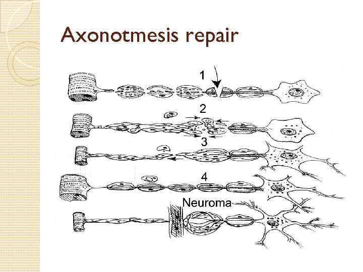 Axonotmesis repair 