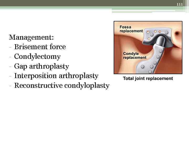 111 Management: - Brisement force - Condylectomy - Gap arthroplasty - Interposition arthroplasty -