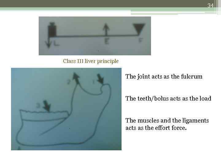 34 Class III liver principle The joint acts as the fulcrum The teeth/bolus acts