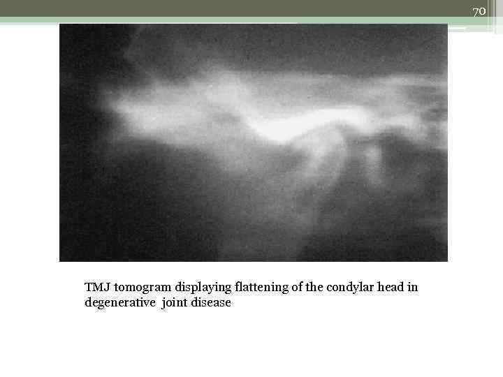 70 TMJ tomogram displaying flattening of the condylar head in degenerative joint disease 