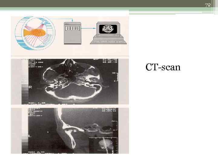 72 CT-scan 