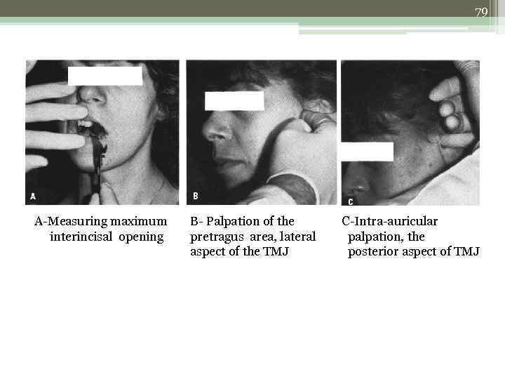 79 A-Measuring maximum interincisal opening B- Palpation of the pretragus area, lateral aspect of