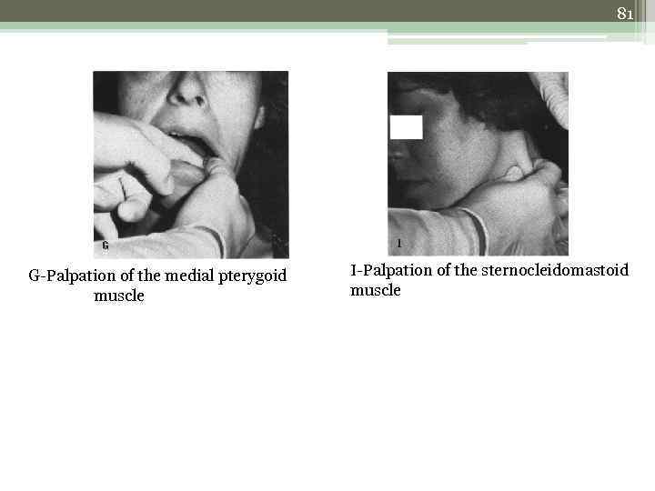 81 G-Palpation of the medial pterygoid muscle I-Palpation of the sternocleidomastoid muscle 