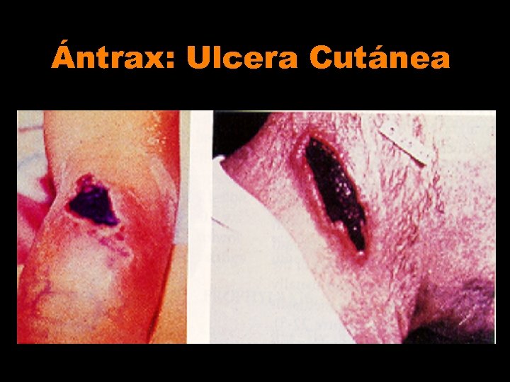 Ántrax: Ulcera Cutánea 