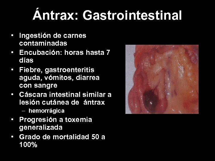 Ántrax: Gastrointestinal • Ingestión de carnes contaminadas • Encubación: horas hasta 7 días •