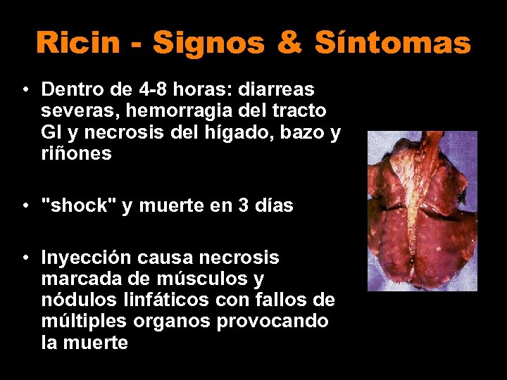 Ricin - Signos & Síntomas • Dentro de 4 -8 horas: diarreas severas, hemorragia