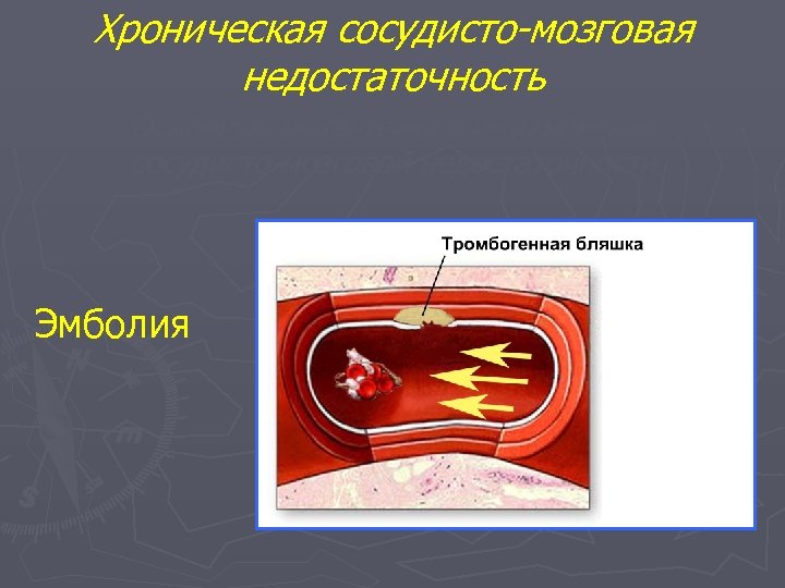 Хроническая сосудисто-мозговая недостаточность Основные механизмы возникновения сосудисто-мозговой недостаточности Эмболия 