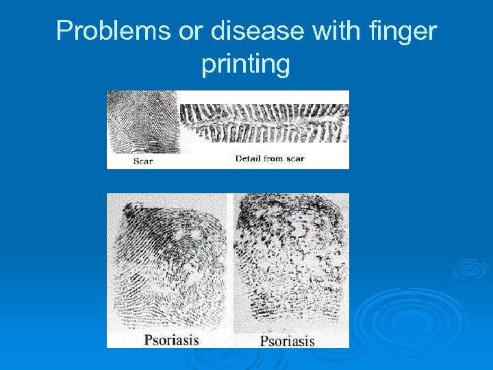 Problems or disease with finger printing 
