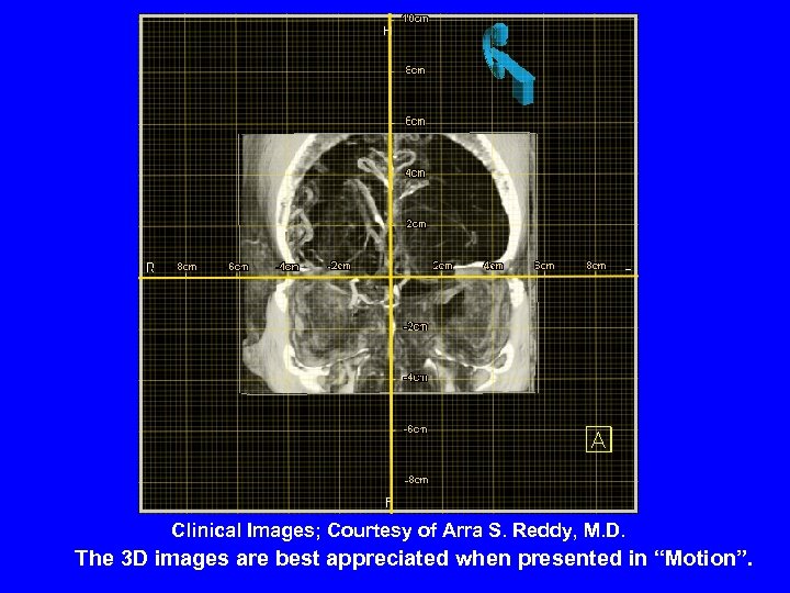 Clinical Images; Courtesy of Arra S. Reddy, M. D. The 3 D images are