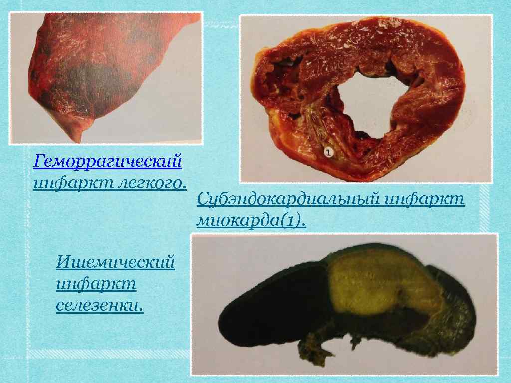 Геморрагический инфаркт легкого. Ишемический инфаркт селезенки. Субэндокардиальный инфаркт миокарда(1). 