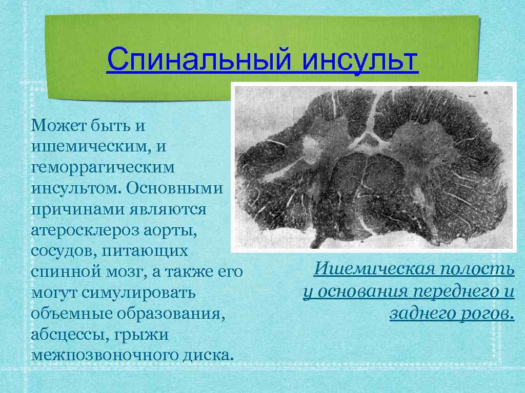 Спинальный инсульт Может быть и ишемическим, и геморрагическим инсультом. Основными причинами являются атеросклероз аорты,