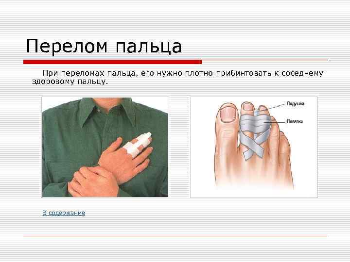 Перелом пальца При переломах пальца, его нужно плотно прибинтовать к соседнему здоровому пальцу. В