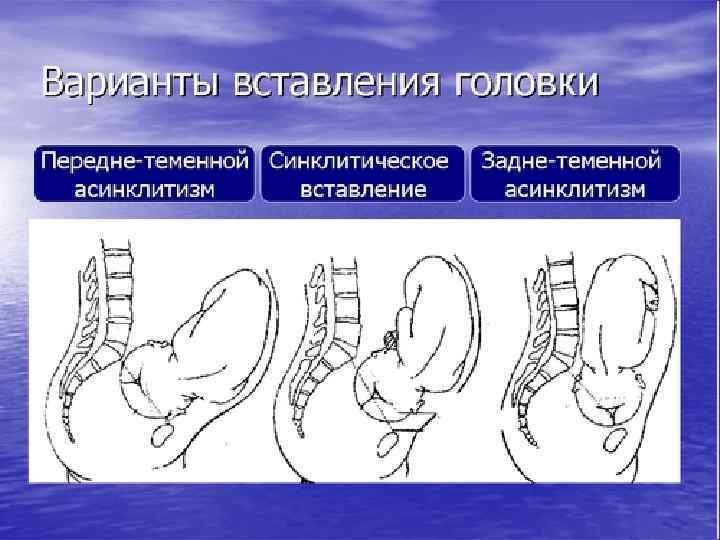 Вставление головки виды