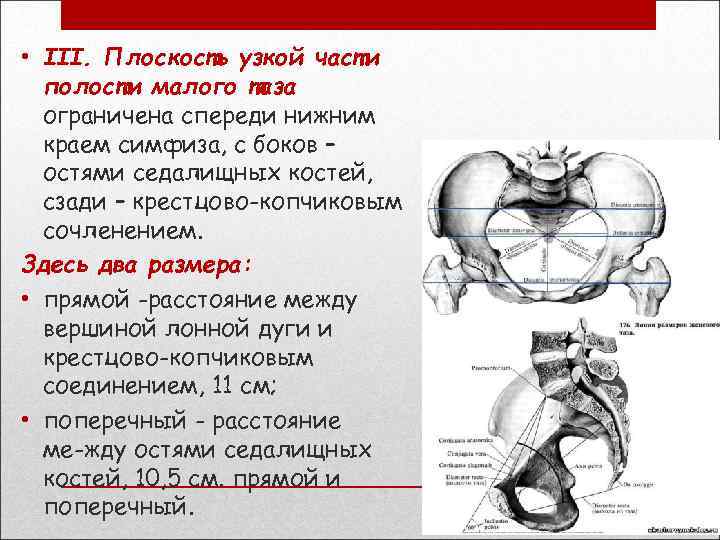  • III. Плоскость узкой части полости малого таза ограничена спереди нижним краем симфиза,