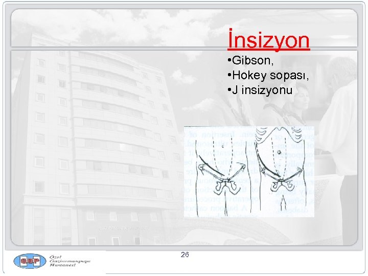 İnsizyon • Gibson, • Hokey sopası, • J insizyonu 26 