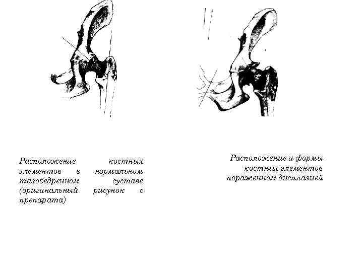 Расположение элементов в тазобедренном (оригинальный препарата) костных нормальном суставе рисунок с Расположение и формы