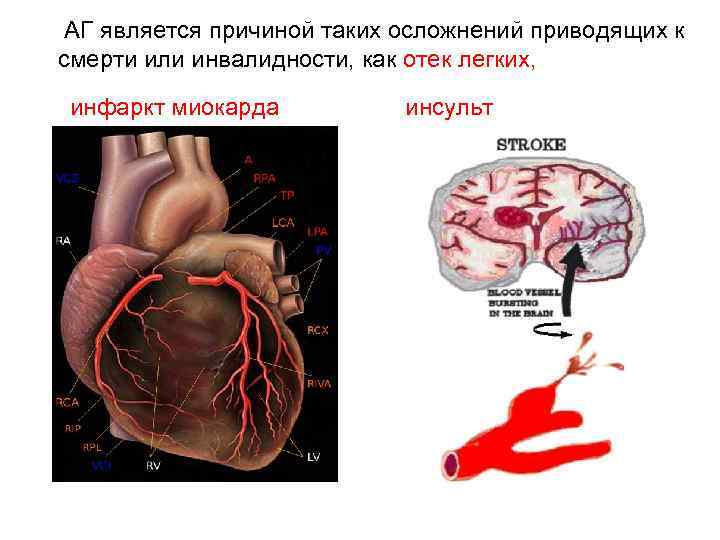 АГ является причиной таких осложнений приводящих к смерти или инвалидности, как отек легких, инфаркт