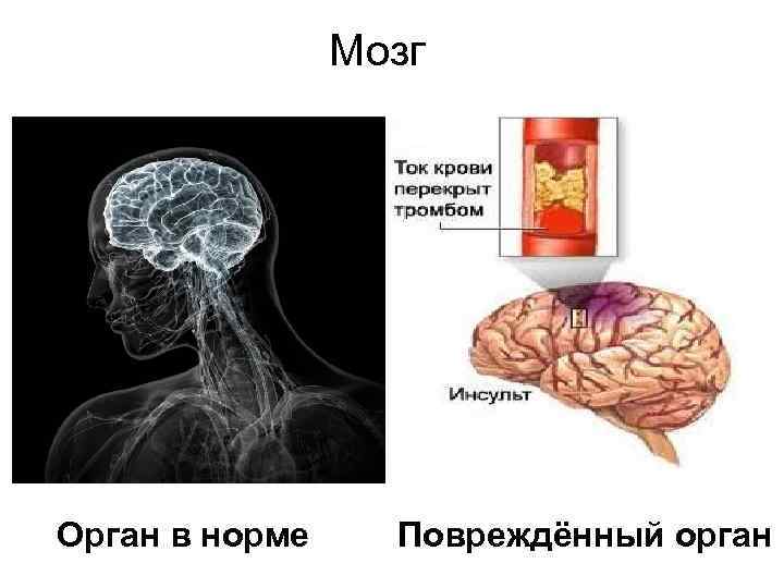 Мозг • • • Мозг Сердце Почки Глаза Нижние конечности Орган в норме Повреждённый