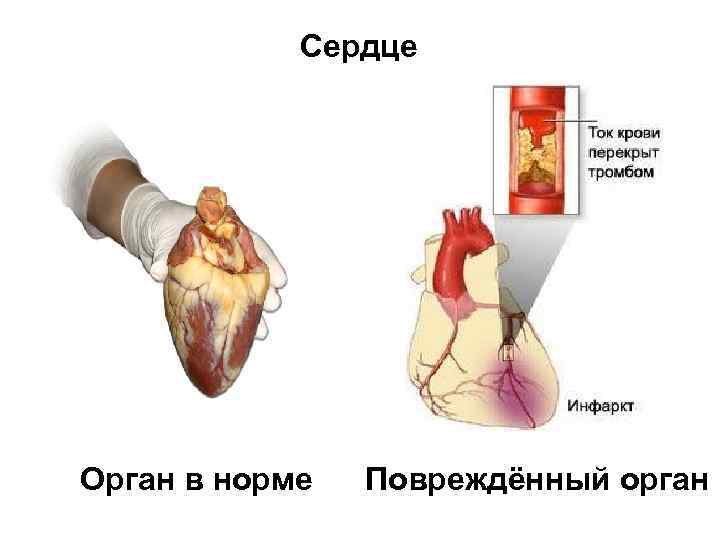 Сердце Орган в норме Повреждённый орган 