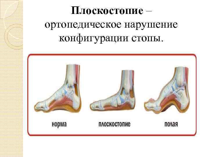 Плоскостопие – ортопедическое нарушение конфигурации стопы. 