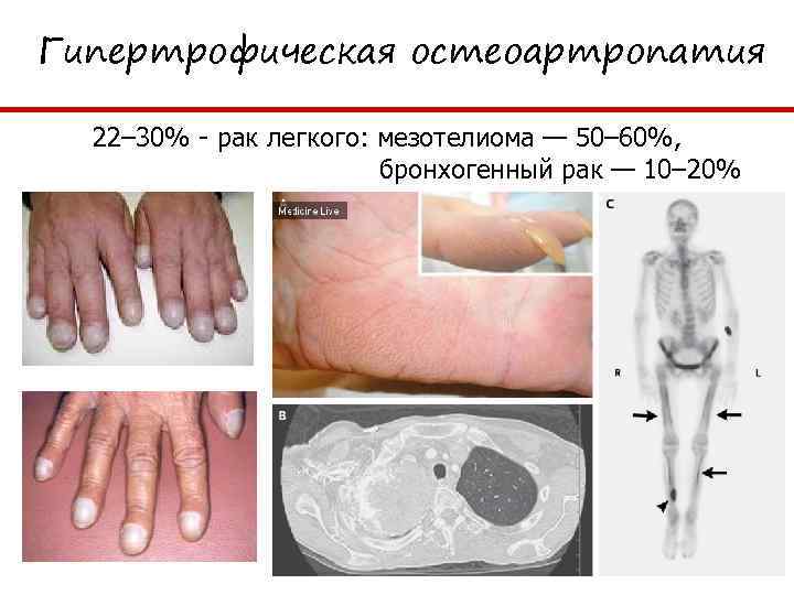 Гипертрофическая остеоартропатия 22– 30% - рак легкого: мезотелиома — 50– 60%, бронхогенный рак —