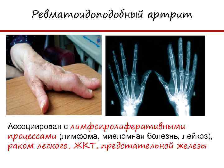 Ревматоидоподобный артрит Ассоциирован с лимфопролиферативными процессами (лимфома, миеломная болезнь, лейкоз), раком легкого, ЖКТ, предстательной