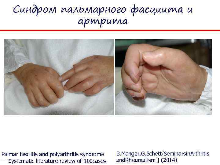 Синдром пальмарного фасциита и артрита Palmar fasciitis and polyarthritis syndrome — Systematic literature review