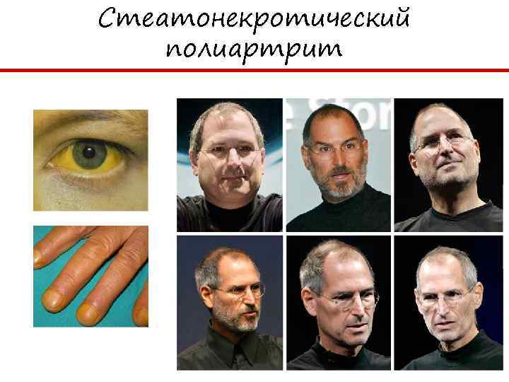 Стеатонекротический полиартрит 