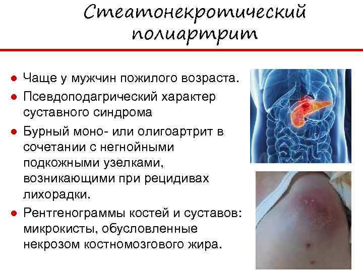 Стеатонекротический полиартрит ● Чаще у мужчин пожилого возраста. ● Псевдоподагрический характер суставного синдрома ●