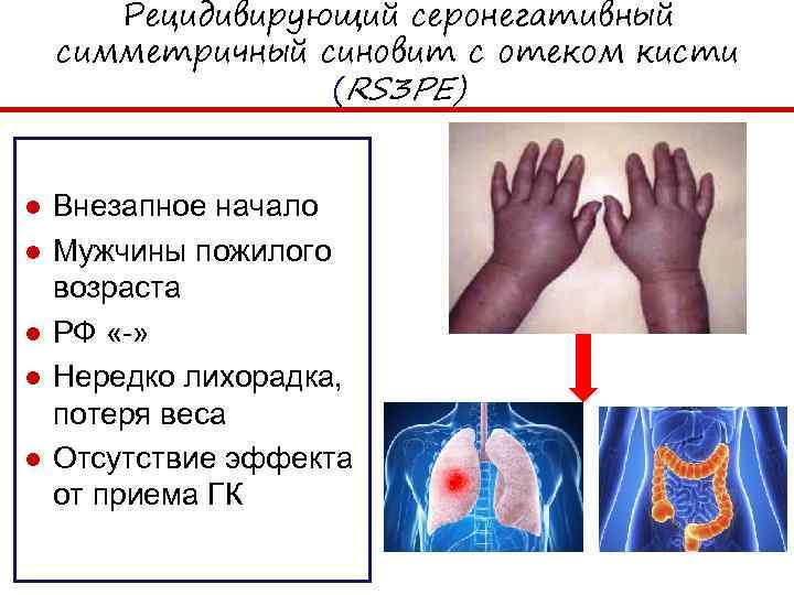 Рецидивирующий серонегативный симметричный синовит с отеком кисти (RS 3 PE) ● Внезапное начало ●