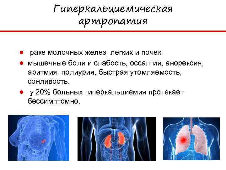 Гиперкальциемическая артропатия ● раке молочных желез, легких и почек. ● мышечные боли и слабость,