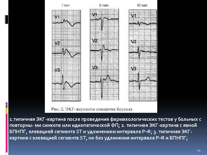 Изменения реполяризации нижней стенки