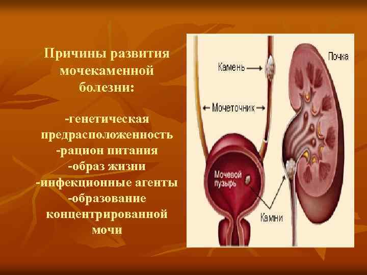 Причины развития мочекаменной болезни: -генетическая предрасположенность -рацион питания -образ жизни -инфекционные агенты -образование концентрированной