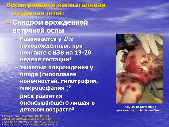 Врожденная и неонатальная ветряная оспа: • Синдром врожденной ветряной оспы – Развивается у 2%