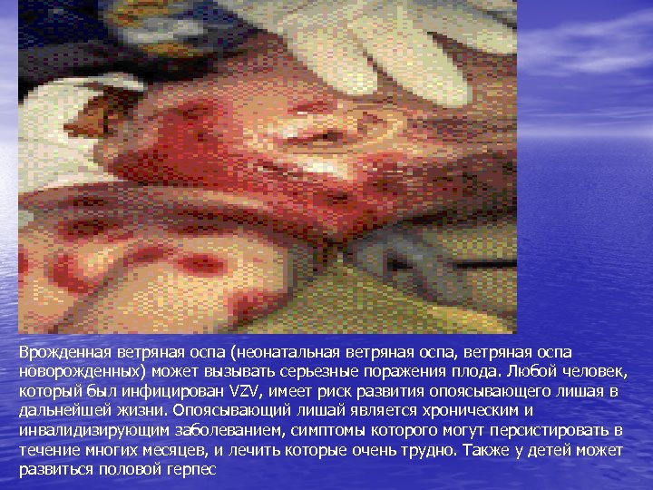 Врожденная ветряная оспа (неонатальная ветряная оспа, ветряная оспа новорожденных) может вызывать серьезные поражения плода.