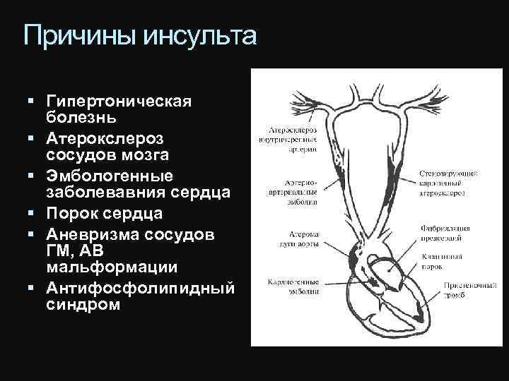 Причины инсульта Гипертоническая болезнь Атерокслероз сосудов мозга Эмбологенные заболевавния сердца Порок сердца Аневризма сосудов