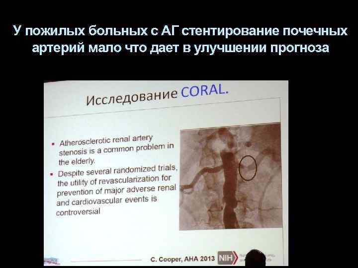 У пожилых больных с АГ стентирование почечных артерий мало что дает в улучшении прогноза